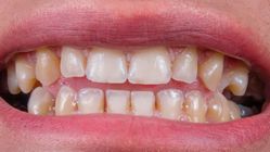 Makanan Asam: Bahaya bagi Gigi dan Cara Mencegah Kerusakan 1 AA1KC3L4